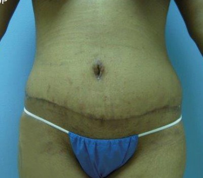 Liposuction before and after - after