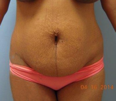 Liposuction before and after - before