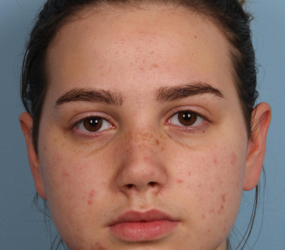 Rhinoplasty before and after - after
