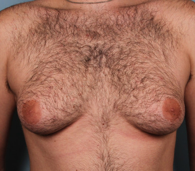 Procedure before and after - before