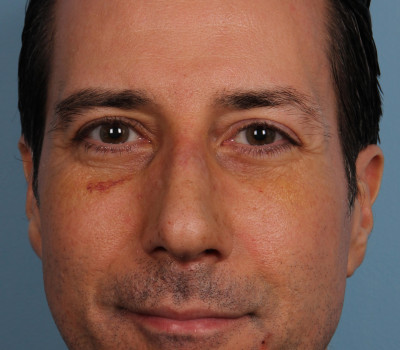 Rhinoplasty before and after - after