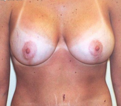 Breast Augmentation before and after - after