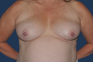 Breast Reconstruction before — Dr. Michael Dobryansky