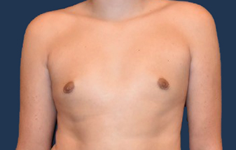Gynecomastia (Male Breast Reduction) before and after - after