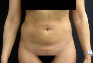 Liposuction before and after - after