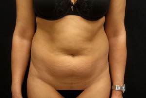 Liposuction before and after - before