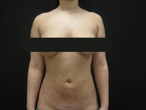 Liposuction before and after - after