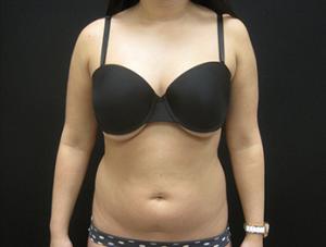 Liposuction before and after - before