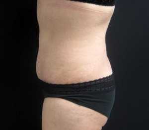 Tummy Tuck before and after - after