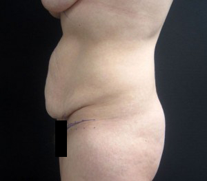 Tummy Tuck before and after - before