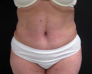 Tummy Tuck before and after - after