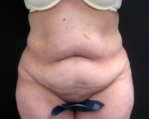 Tummy Tuck before and after - before