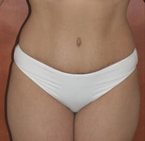 Tummy Tuck before and after - after