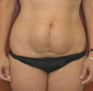 Tummy Tuck before and after - before