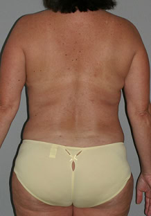 Liposuction before and after - after