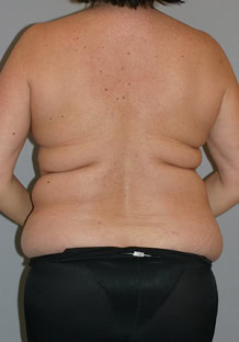 Liposuction before and after - before
