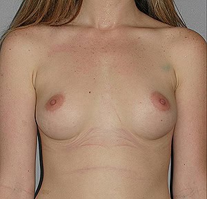 Procedure before and after - before