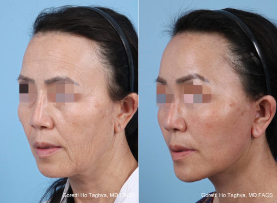 Facelift after — Dr. Goretti Taghva
