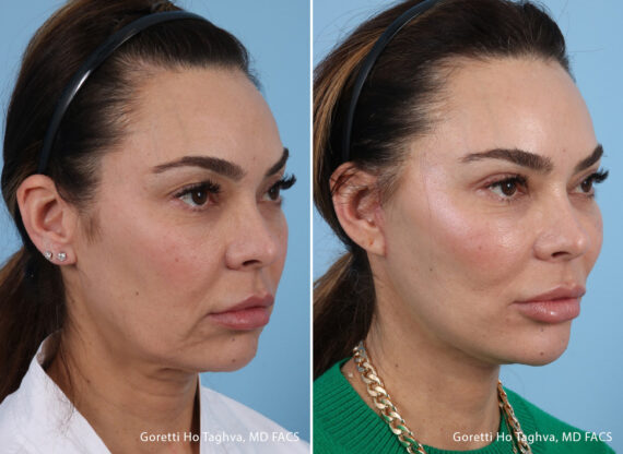 Facelift after — Dr. Goretti Taghva