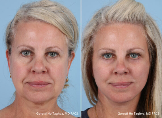 Facelift before — Dr. Goretti Taghva