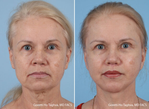 Facelift after — Dr. Goretti Taghva