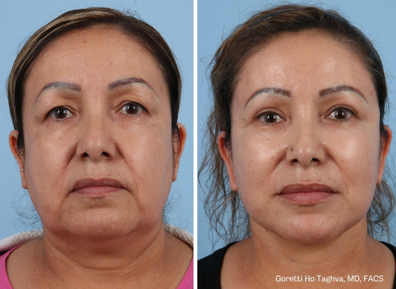 Facelift after — Dr. Goretti Taghva