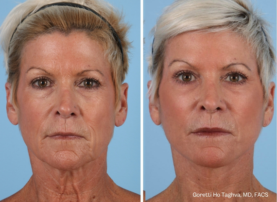 Facelift before — Dr. Goretti Taghva