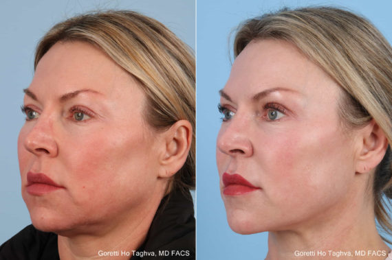 Facial Fat Transfer after — Dr. Goretti Taghva