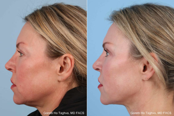 Facelift after — Dr. Goretti Taghva