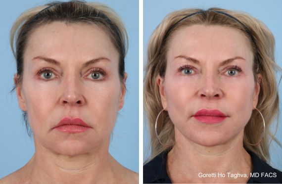Deep Plane Facelift and Fat Transfer before and after - after