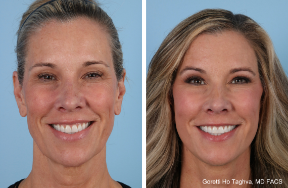 Deep Plane Facelift and Fat Transfer before and after - before