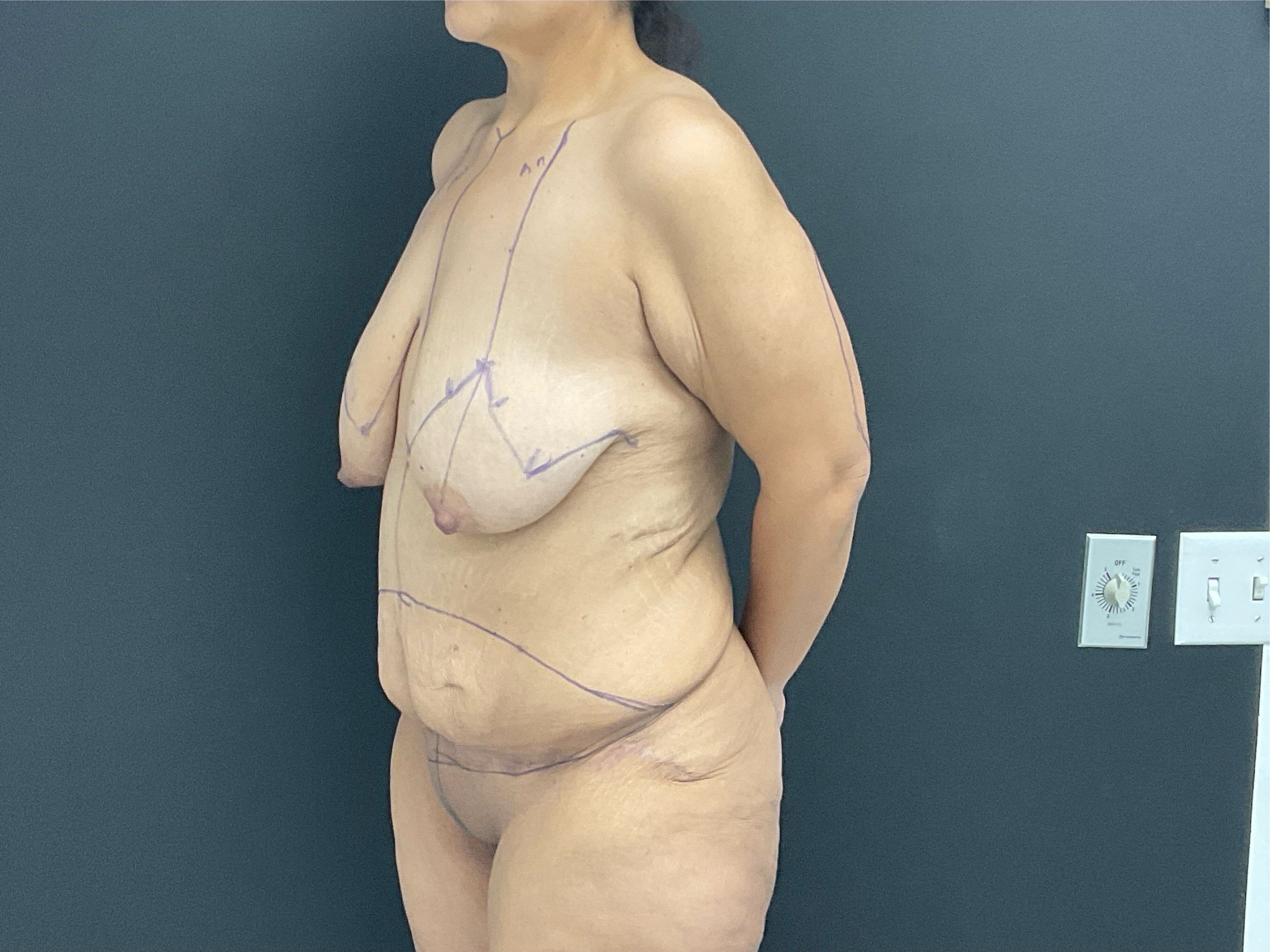Abdominoplasty before and after - before