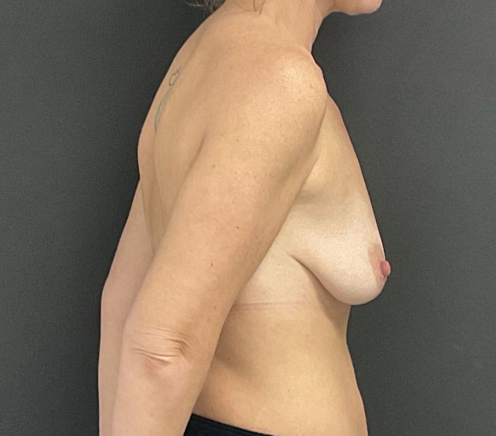 Bilateral Mastopexy and Augmentation before and after - before