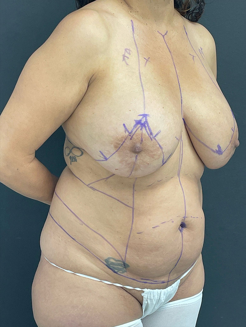 Bilateral Breast Implant Removal before and after - before