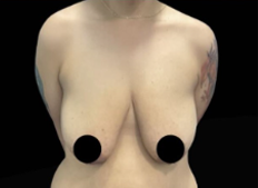 Natural Breast Lift before and after - before