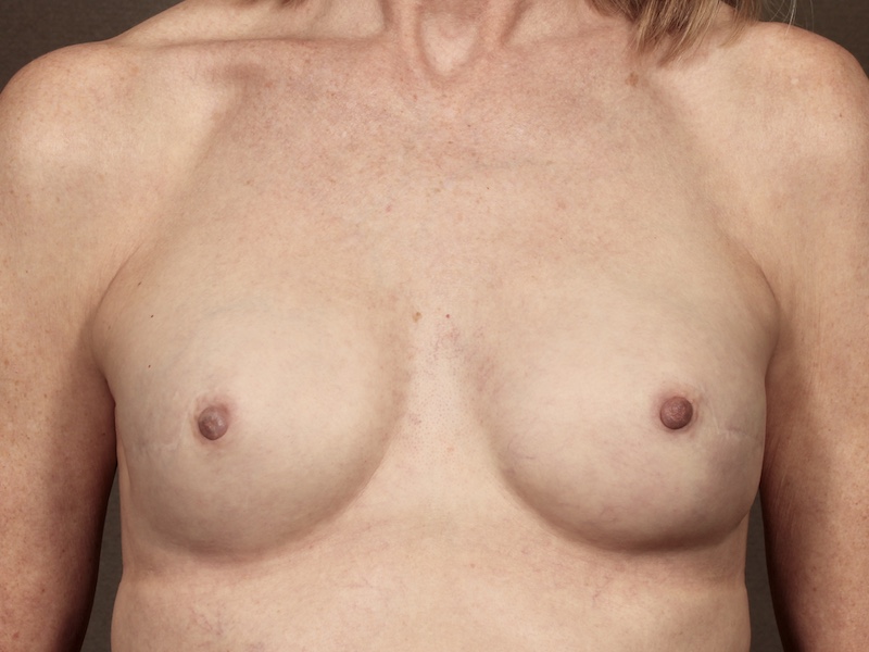 Breast Reconstruction after — Dr. Nikolas Mcenerney