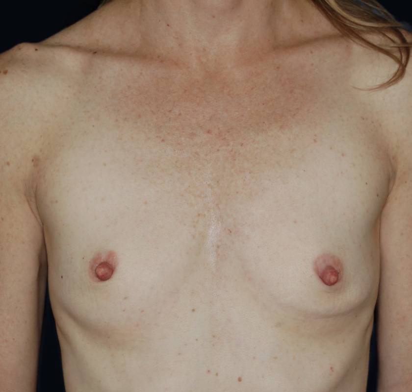 Breast Augmentation before and after - before