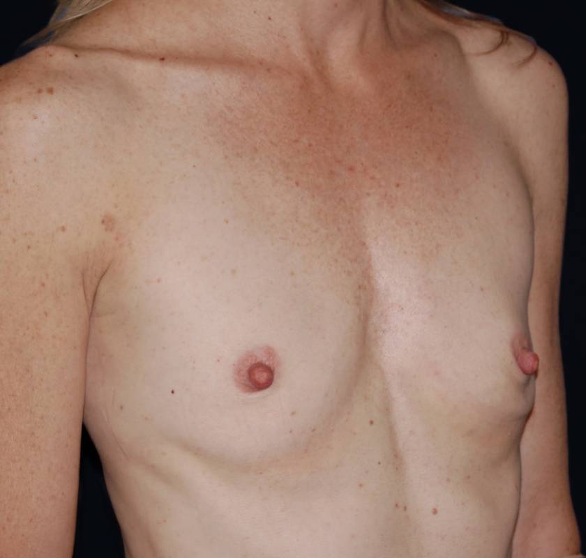 Breast Augmentation before and after - before