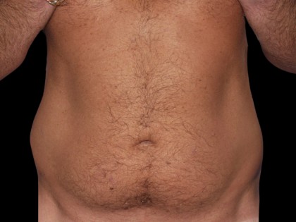 Procedure before and after - before