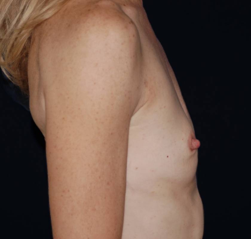 Breast Augmentation before and after - before