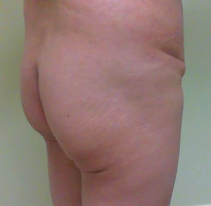 Brazilian Butt Lift before and after - before