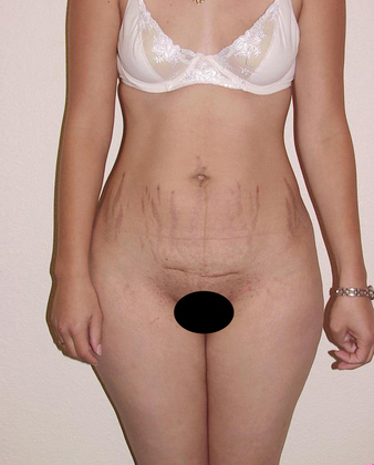 Abdominoplasty before and after - before