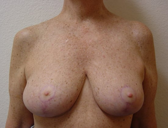 Breast Reduction before and after - after