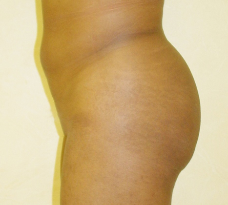 Brazilian Butt Lift before and after - before
