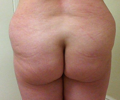Brazilian Butt Lift before and after - before