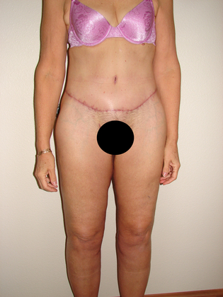 Body Contouring before and after - after