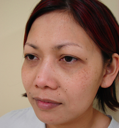 Blepharoplasty before and after - before