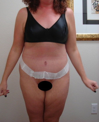 Abdominoplasty before and after - after