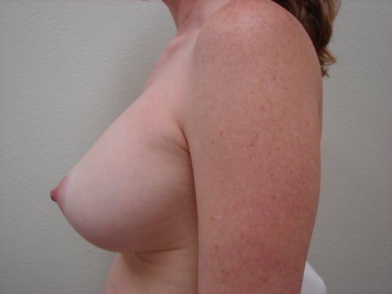 Breast Implants before and after - after