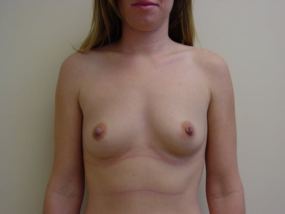 Breast Augmentation before and after - before